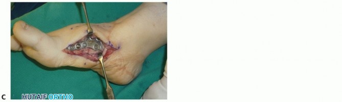 Illustration 51 for Mastering Midfoot Arthrodesis: Protect the Deep Neurovascular Bundle