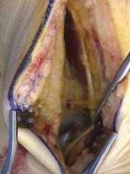 Illustration 18 for Talar Neck Fracture Treatment: Optimizing Recovery with ORIF