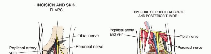 Illustration 9 for Complex Popliteal Resections: Protecting the Greater Saphenous Vein