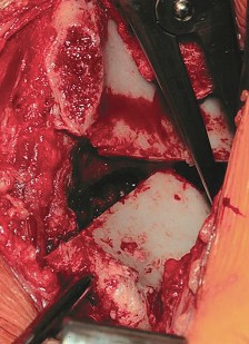 Illustration 51 for Bernese PAO: Unlocking the Procedure with Level V Evidence Insights