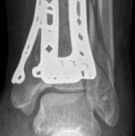 Illustration 24 for Decoding Pilon Fractures: Anterolateral and Medial Fragments Revealed