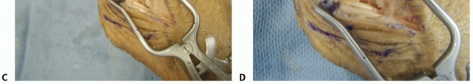 Illustration 18 for Lateral Ankle Repair: Maximize Stability with Interference Screw Fixation