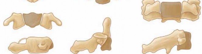 Illustration 3 for Cervical Fusion: The Line is Drawn for Lasting Stability