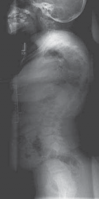 Thoracoscopic Fusion: Treating Scoliosis & Neural Axis Abnormalities