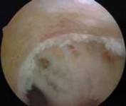 Illustration 9 for Successful Ligament Repair Revision: Fixing Failed ACLs