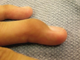 Bent Finger? Identify & Treat Your Soft Tissue Mallet Now