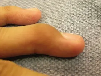 صورة توضيحية لـ إصبع المطرقة اللحمي: دليل شامل لفهم وعلاج هذه الإصابة الشائعة في اليد