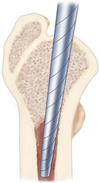 Illustration 23 for Cementless Femoral Stems: Master Indications & Avoid Pitfalls