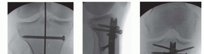 Illustration 44 for Advanced Nailing of the Mature Tibia: Overcoming Complexities