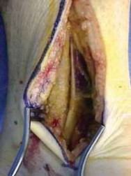 Illustration 17 for Talar Neck Fracture Treatment: Optimizing Recovery with ORIF