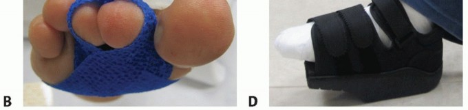 Illustration 47 for Plantar Plate Repair: End Lesser Toe Pain & Instability