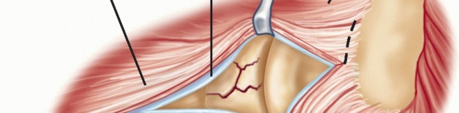 Illustration 12 for Radial Head Arthroplasty: Restoring Elbow Function & Stability