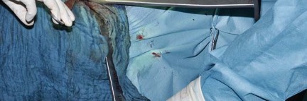 Illustration 51 for Collum Femoris Preserving: Achieve Better Primary Hip Outcomes