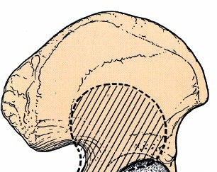 Illustration of acetabulum posterior approach - Dr. Mohammed Hutaif
