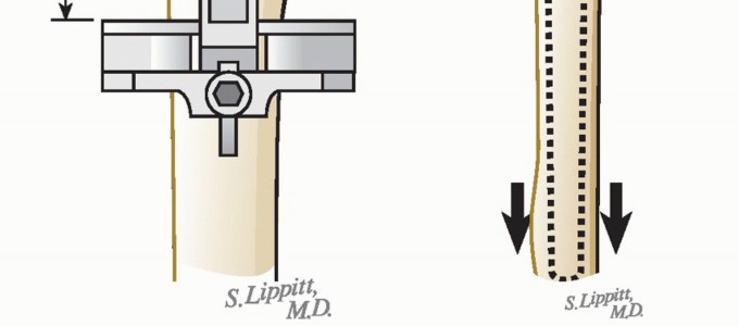 Illustration 24 for Hemiarthroplasty for Proximal: Effective Treatment for Fractures