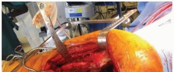 Illustration 15 for Extended Trochanteric Osteotomy: How et al Extended Revision THA Solutions