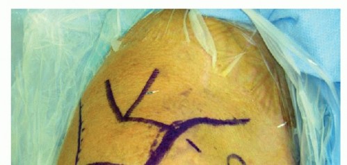 Illustration 5 for Find Relief: Arthroscopic Subacromial Decompression for Impingement