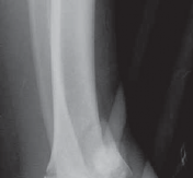 Illustration 20 for Optimizing ORIF for Tibial Plafond Fractures: A Modern Approach