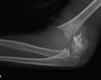 Illustration 2 for Pediatric Supracondylar Humerus Fractures: Case & Management