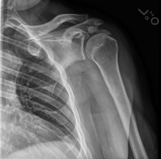Illustration 83 for Acad Orthop Surg Challenge: Diagnose Shoulder Pain Case 1