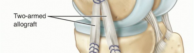Illustration 14 for Repair & Recover from Collateral Ligament Injuries: Your Guide