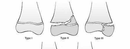 Illustration 11 for Master Pediatric Femoral Shaft & Knee Fractures: Interactive Module