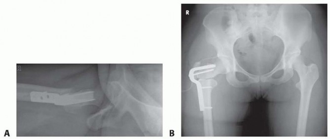 Illustration 3 for Proximal Femoral Osteotomy: When This Hip-Saving Surgery Is Performed