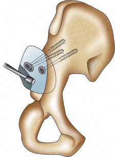Illustration 116 for Successful Total Hip Replacement in Developmental Dysplasia