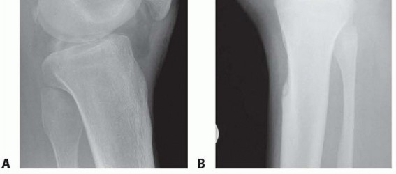 Illustration 2 for Posterior Cruciate Ligament Surgery: Regain Knee Strength & Stability
