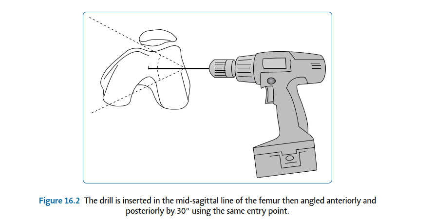Illustration 5 for Crucial Positioning for General Anaesthesia in Pediatric Orthopaedics