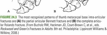CRIF vs ORIF for Hand Fractures: Understanding Your Treatment Options