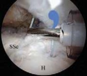 Illustration 33 for Arthroscopic Subscapularis Repair: The lo iky brady Method for Stability