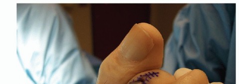 Illustration 31 for Hammer Toe Correction: Understanding the Extensor Digitorum Longus