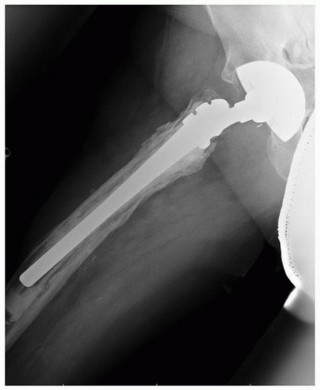 Illustration 9 for Mastering Revision THA: Strategies for Adverse Local Tissue Challenges