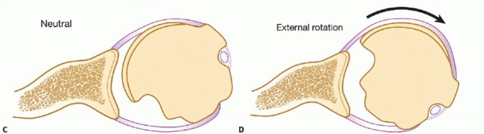 Illustration 5 for Latarjet for Instability: Bone Loss Solutions, Per Burkhart SS, Lo
