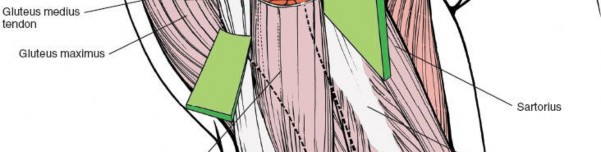 Illustration 5 for Unlocking Every Aspect of the Hip's Surgical Approaches