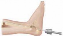Illustration 13 for Solving Congenital Pseudarthrosis: Tibia with the Williams Rod