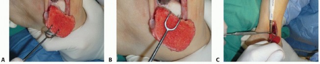 Illustration 17 for Painful Talus Lesions? The tech fig c Osteochondral Transfer Solution