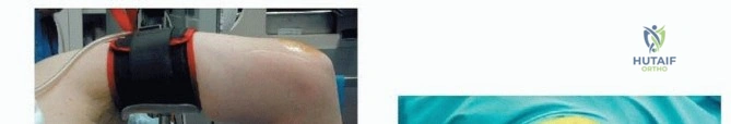 Chevron-Akin Double Osteotomy: Comprehensive Surgical Technique and Biomechanics