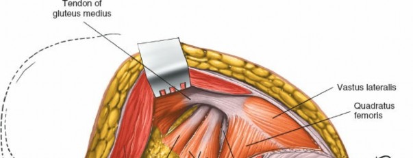 Illustration 180 for Unlocking Every Aspect of the Hip's Surgical Approaches