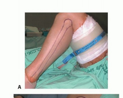 Illustration 22 for Free Vascularized Fibular Grafts: Solving Complex Bone Defects