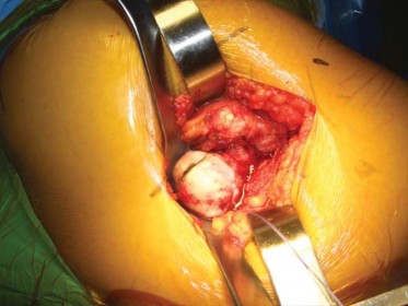 Illustration 68 for Successful Total Hip Replacement in Developmental Dysplasia