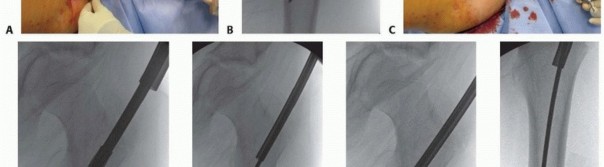 Illustration 14 for Pediatric Femoral Nailing: Targeting the Right aspect of the greater Trochanter