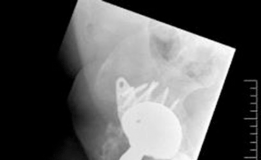 Illustration 9 for Solving Severe Acetabular Bone Loss with Cup-Cage Reconstruction