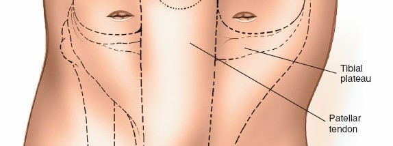 Illustration 6 for Mastering Knee Approaches: Spotlight on Superficial Medial Ligament