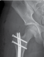 Illustration 39 for Limb Reconstruction: Restoring Function for Challenges Near and Far