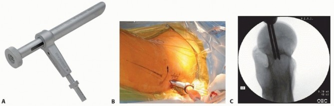 Illustration 22 for Achieve Optimal Femoral Head Fixation with Cephalomedullary Nailing