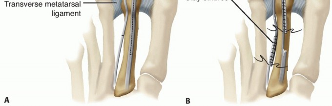 Illustration 13 for Toe Deformity Pain? Rebalance Flexor to Extensor for Relief