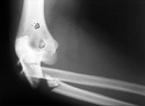 صورة طبية: دليل الأستاذ الدكتور محمد هطيف الشامل لأمراض وإصابات اليد والمعصم في صنعاء