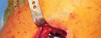 Illustration 56 for Exploring the Ambulatory Surgical Setting for Total Hip Replacement